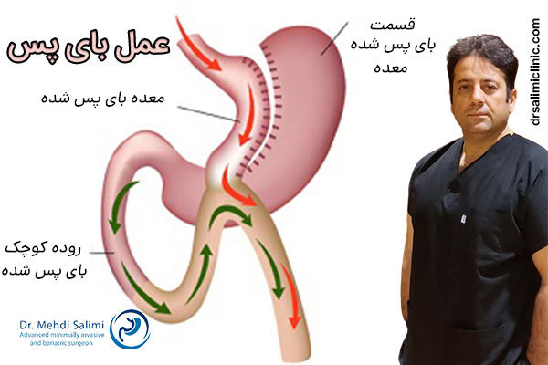 عمل بای پس معده