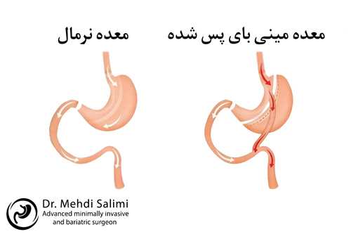 جراحی مینی بای پس معده