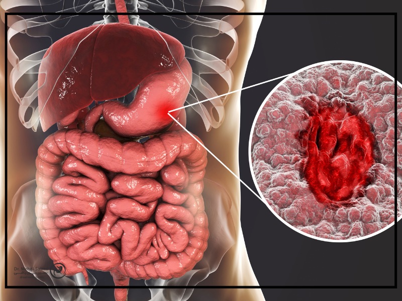 علائم زخم معده بعد از عمل بای پس معده
