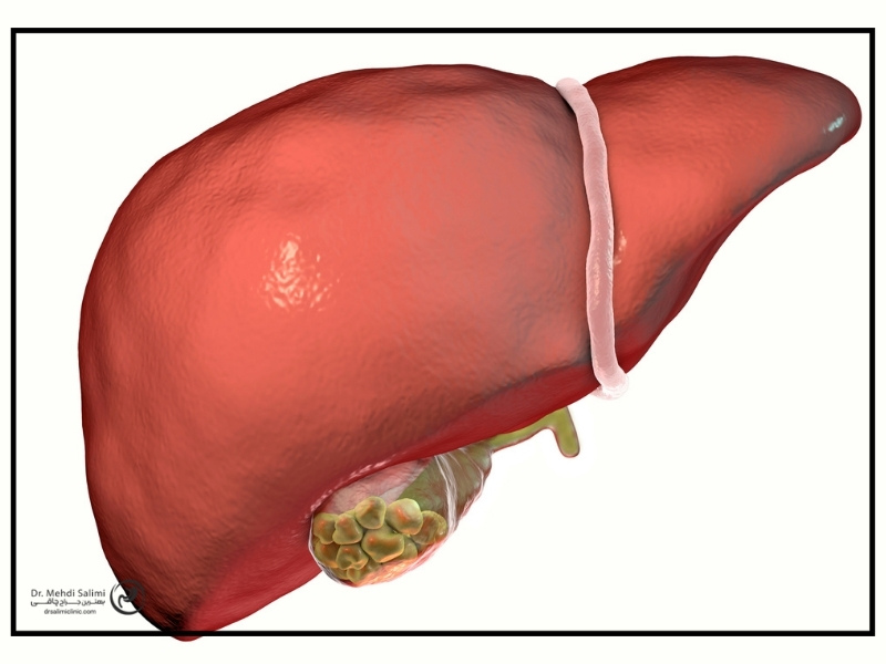 تشخیص سنگ کیسه صفرا