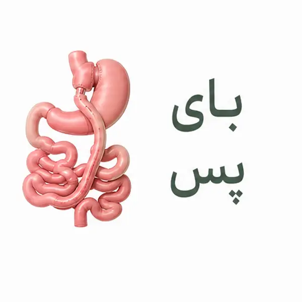 بای‌پس معده